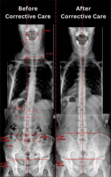 Chiropractic Walnut Creek CA X-Ray Chiropractic Walnut Creek CA X-Ray